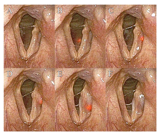 광유도 성대주입술의 후두경 소견.􀀁 바늘의 첨단의 광원으로 바늘의 위치를 쉽게 확인하 수 있음