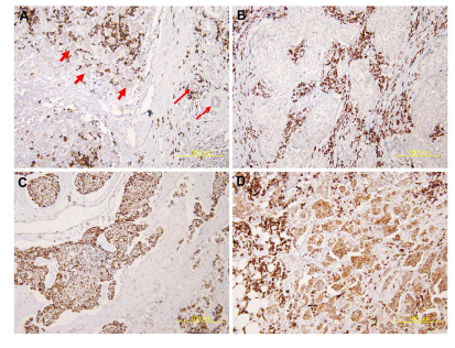 Representative immunohistochemical results for CD9 expression. A, Non-neoplastic epithelial cells of mammary glands (thick arrows) and ducts (thin arrows) are negative or weakly positive for CD9 expression. Stromal immune cells, but not all, show strong immunoreactivity for CD9. B, The tumour cells are negative for CD9 expression, but most of the stromal immune cells show strong immunoreactivity for CD9. C, In this case, CD9 is strongly expressed on tumour cells, but positive stromal immune cells are scanty. D, This case shows strong CD9 expression in both tumour cells and stromal immune cells