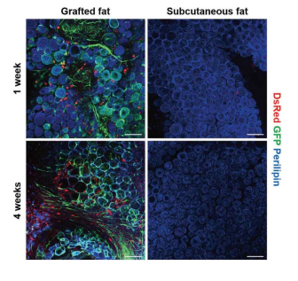 Distribution of intravenously injected DsRed adipose-derived stromal cells by immunofluorescent staining. A high number of DsRed adipose-derived stromal cells were recruited to grafted green fluorescent protein (GFP) fat (above, left), whereas very few DsRed adipose-derived stromal cells were observed in subcutaneous fat (above, right) at postoperative week 1. (Below) These results were similar in grafted and subcutaneous fat at postoperative week 4. Scale bars = 100 μm