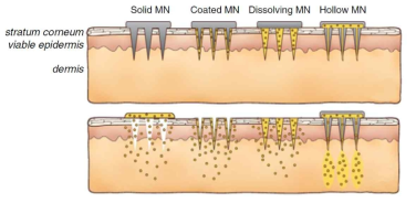 마이크로니들 종류에 따른 피부로의 약물전달 방법