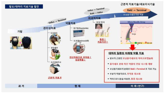 탈모 질환 치료기술 발전상과 미래 연구 전망