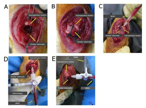 Repair procedures of the torn supraspinatus tendon to the greater tuberosity in a transosseous manner. (A) Two suture ends for the medial row and lateral row were passed through the 2 bone tunnels. (B) Each suture end was then tied over the lateral humeral cortex, reattaching the supraspinatus tendon to the footprint. (C) The BMAC was injectioned on the repair site.(D) The BMAC +Atelocollagenwas injectioned on the repair site. (E) The BMAC + polydexyribonucleotide(PDRN) was injectioned on the repair site