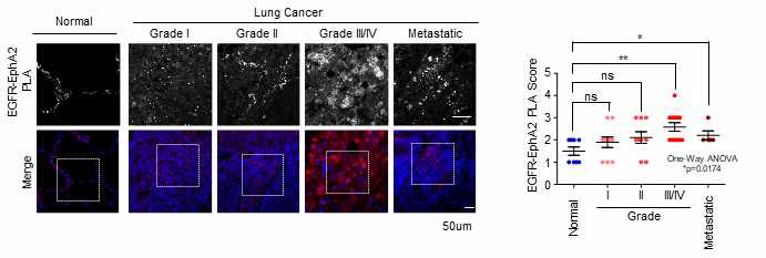 폐암 진행애 따른 EphA2과 EGFR의 결합 양상