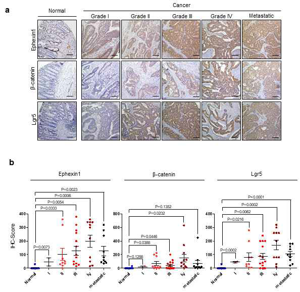 악성화가 진행된 대장암 조직에서 Ephexin1 및 b-catenie, LRP5 발현 양상