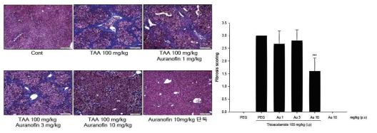 Masson’s Trichrome staining과 fibrosis score