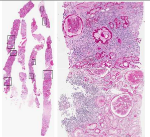 당뇨병성신증 조직 Periodic acid Sciff 염색