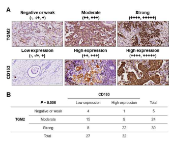 위암 조직에서 TGM2 및 CD163의 발현