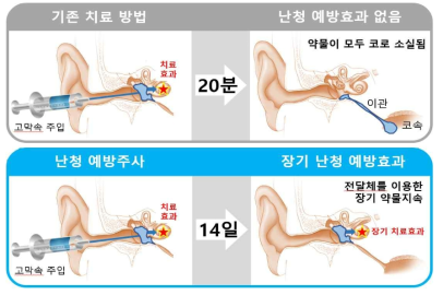 난청 예방/치료를 위한 고실내 약물 주입 모식도. 고막 안 고실내에 전달체와 약물을 함께 주입하였을 경우 전달체와 약물이 이관을 통해 빠져나가지 않고 고실내에 장기간 머물며 지속적으로 약물을 방출함. 한번의 처치로 장기간 예방 효과를 기대할 수 있음