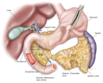 췌도 결찰 (Pancreatic duct ligation) 수술 모식도 (본 과제에서는 그림에서처럼 췌장 전체를 결찰하지 않고 췌도(PD)만 결찰하였음)