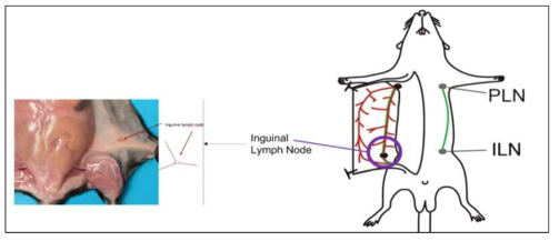 서혜 림프절 샘플링 부위