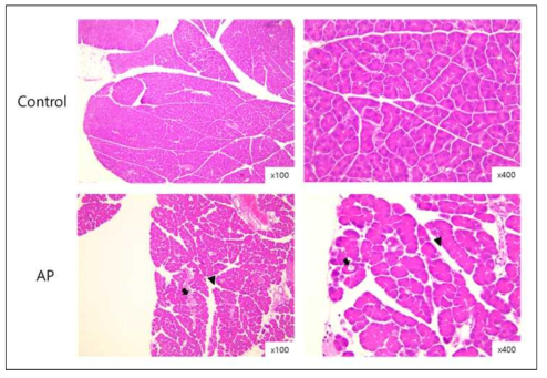 대조군(control) 및 급성 췌장염 유도군(AP)에서 췌장 조직의 H&E 염색 사진. 유도군에서 선방세포 변성(화살표) 및 간질사이 조직의 부종(화살표 머리)가 관찰되었음