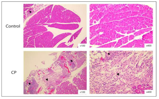 대조군(control) 및 만성 췌장염 유도군(chronic pancreatitis)에서 췌장 조직의 H&E 염색 사진. 염증세포 침윤(화살표) 및 섬유증(화살표 머리)가 관찰되었음