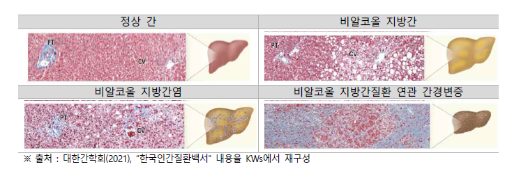 비알코올 지방간질환의 분류와 현미경학적 소견