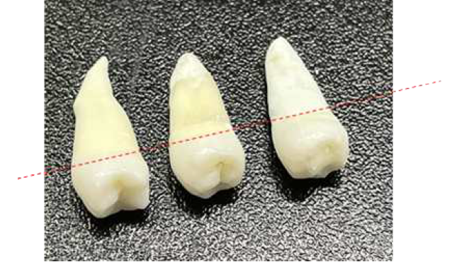 Seperation of Crown/root