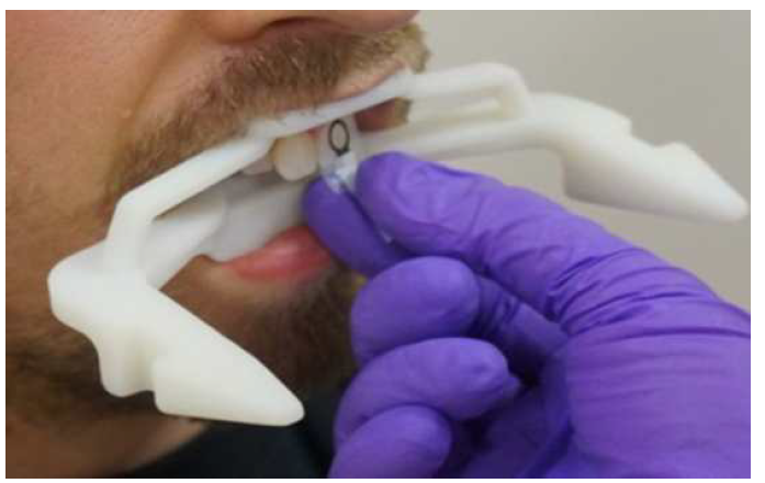 A wireless resonator being placed on an incisor tooth. reference: Wilson Schreiber et al., In Vivo CW-EPR Spectrometer for Dosimetry and Oximetry in Preclinical and Clinical Applications
