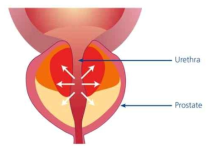알파차단제의 평활근 이완으로 요도 압력 감소