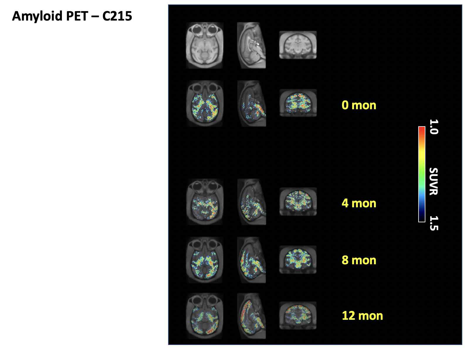 시간 경과에 따른 C215 개체에서의 아밀로이드 PET 뇌 섭취 변화