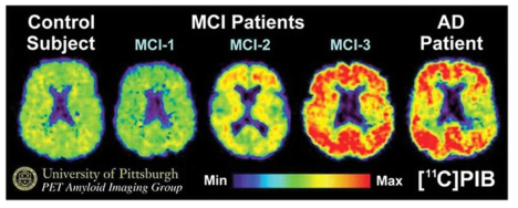 치매의 중증도에 따른 아밀로이드 PET 방사성의약품의 뇌흡수율 변화