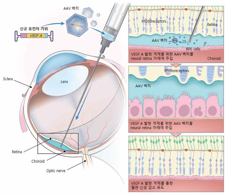 AAV 바이러스 전달체 기반 초소형 유전자 가위의 망막내 전달 및 치료 효과 유도