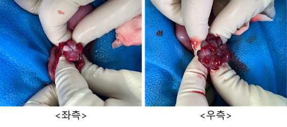 3월 20일 embryo transfer #HB-05, 좌측/우측 난소 상태