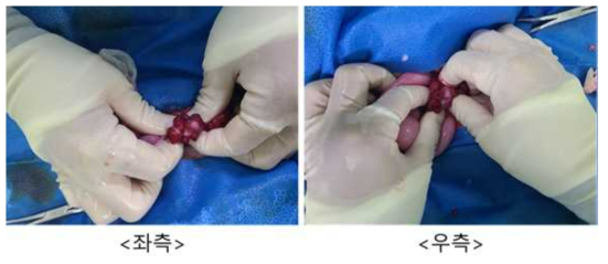 8월 14일 embryo transfer #N6-28, 좌측/우측 난소 상태