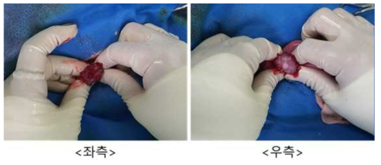 8월 28일 embryo transfer #O8-23, 좌측/우측 난소 상태