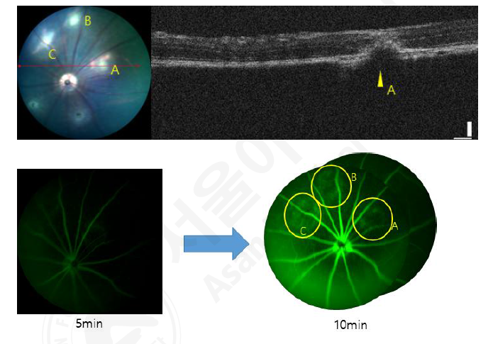(위) 레이저 조사 후 5일차 안저 사진과 OCT 사진. (아래) 레이저 조사 5일차 형광안저혈관조영술 사진(5분, 10분). 레이저 조사부위를 각 A, B, C로 표기하였다