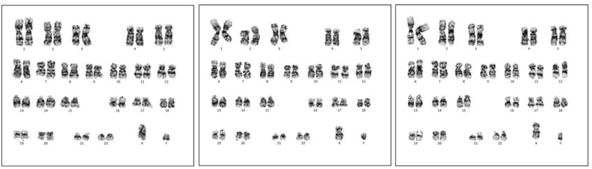 iPSC 36A karyotyping