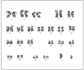 iPSC H4 karyotyping