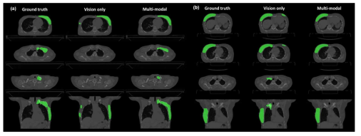 개발한 multimodal radiotherapy target contouring 모델의 성능