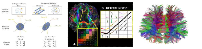 DTI의 tensor 및 신경 섬유 예측 예시와 최종 획득된 tractography.