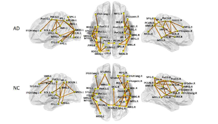 각 그룹별으로 분류하는데 있어 edge-centric GNN이 중요하게 본 뇌 연결을 그린 그림, AD는 알츠하이머 질병을 분류할 때, NC는 정상인을 분류할 때 중점적으로 본 연결을 그린 것임
