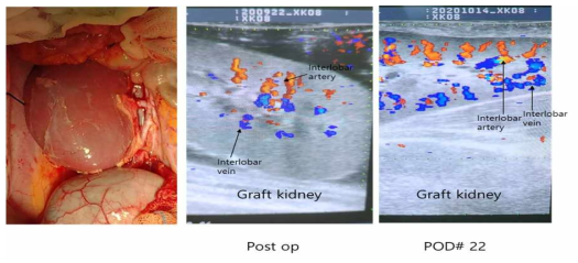 형질전환돼지 신장을 이식받은 2번 개체의 이식 후 육안 및 초음파 소견