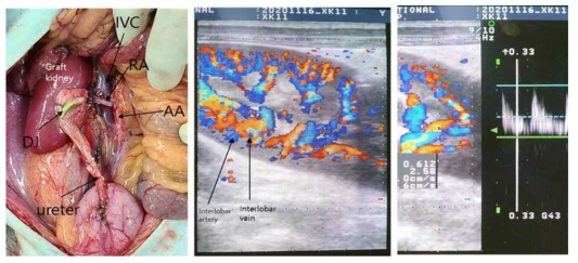 형질전환돼지 신장을 이식받은 5번 개체의 이종신장이식 후 육안 및 초음파 소견