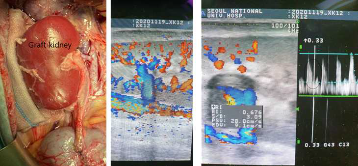 형질전환돼지 신장을 이식받은 6번 개체의 이종신장이식 후 육안 및 초음파 소견