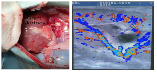 형질전환돼지 신장을 이식받은 7번 개체의 이종신장이식 후 육안 및 초음파 소견