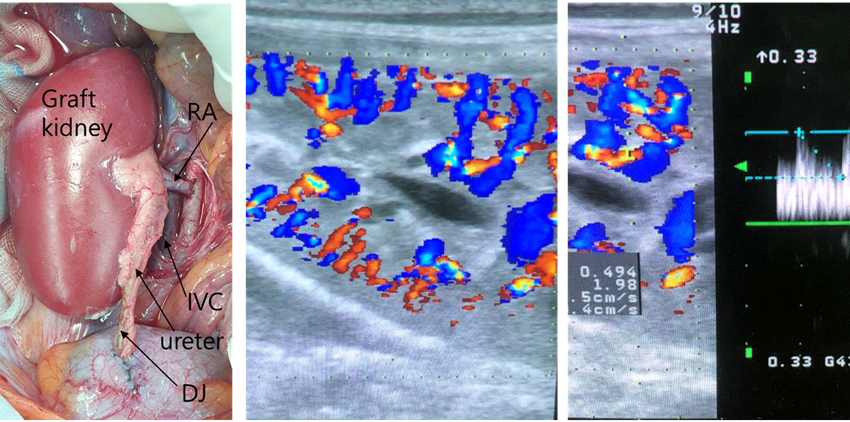 형질전환돼지 신장을 이식받은 8번 개체의 이종신장이식 후 육안 및 초음파 소견