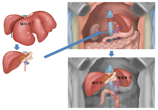 이종 간이식 모식도 (돼지 우측 간 부분 이식편을 이용한 auxiliary 간이식 방법)