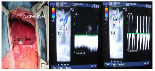 형질전환돼지의 간이식을 받은 2번 개체의 육안소견 및 초음파 소견