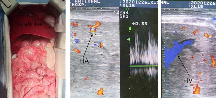 형질전환돼지의 간이식을 받은 7번 개체의 육안소견 및 초음파 소견