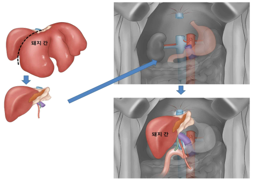 이종 간이식을 위한 수술 모식도 (전체 간 치환법)