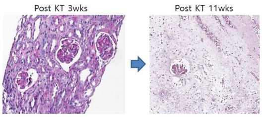 XK-15 이식 3주차, 11주차 조직검사 결과