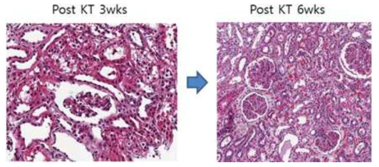 이식 3주차 조직검사 소견과 6주차 조직검사 소견의 변화