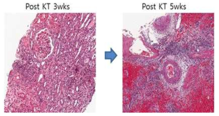 XK-21 이식 3주차 조직검사 소견과 5주차 조직검사 소견의 변화