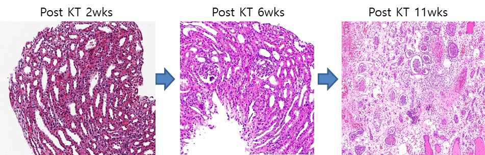 XK-24 이식 2주차 조직검사 소견과 6주차 및 11주차 조직검사 소견의 변화