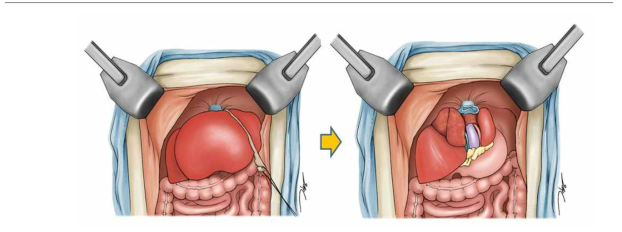 Acute liver failure model 수술의 모식도