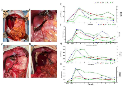 Acute liver failure model 개체의 수술 사진 및 수술 후 임상 경과 A: ALF-1 의 수술사진, B: ALF-2 의 수술사진, C: ALF-3 의 수술사진, D: ALF-4 의 수술사진, E: ALF-1 의 수술 후 간 기능검사 경과, F: ALF-2 의 수술 후 간 기능검사 경과, G: ALF-3 의 수술 후 간 기능검사 경과, H: ALF-4 의 수술 후 간 기능검사 경과