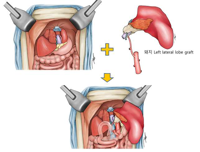 돼지 left lateral lobe graft 간 이종이식 모델 모식도