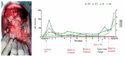 XL-23 의 수술 후 사진과 간기능 검사 수치 변화 추이