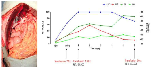 XL-25 의 수술 후 사진과 간기능 검사 수치 변화 추이